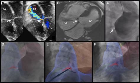 lv ras|Image Fusion Guided Device Closure of Left Ventricle to Right .